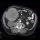 Hepatocellular carcinoma, HCC: CT - Computed tomography